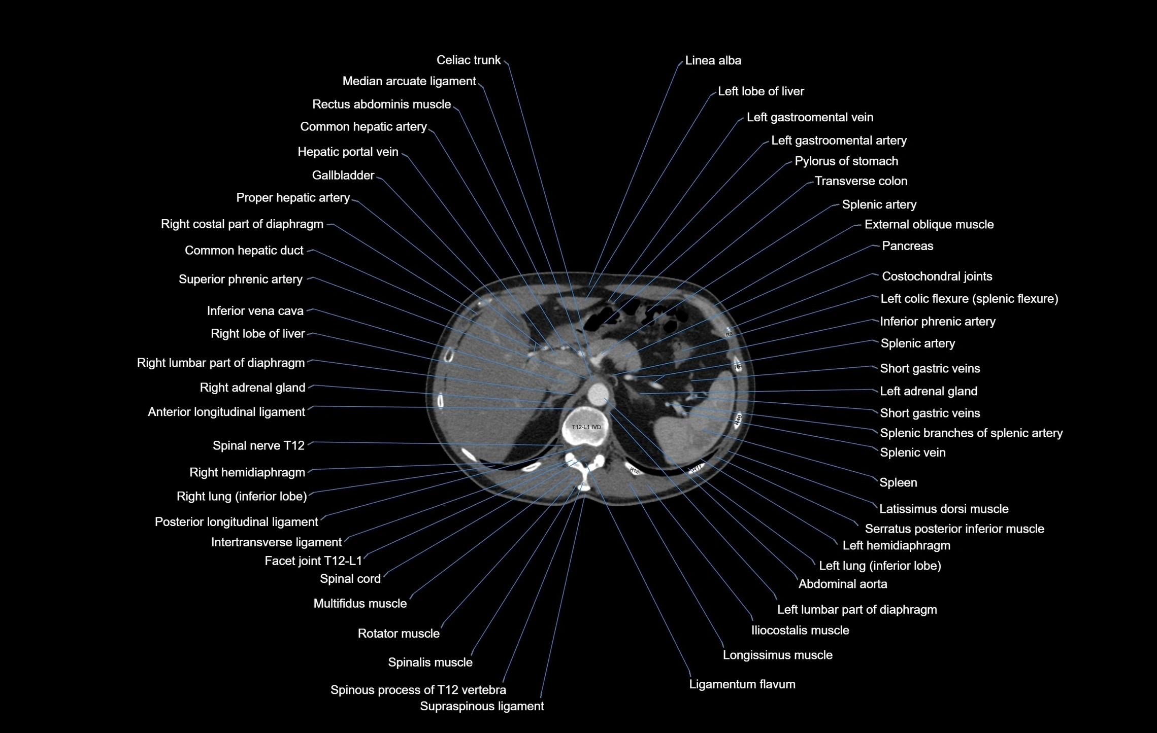 CT chest (thorax) soft tissue window labelled axial cross sectional anatomy radiology image-00120.webp